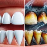 Oral Health Impact of Smoking